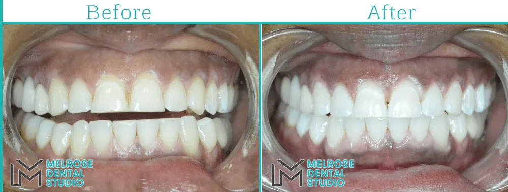 Teeth whitening before and after result, case 1, Melrose Dental Studio
